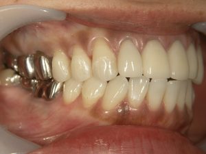 こういう感じの銀歯はだんだん歯肉との境目が合わなくなってきます。