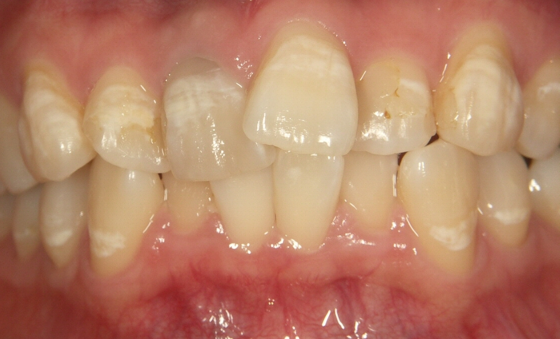 歯の表面の白い縞模様 白い斑点が消えた