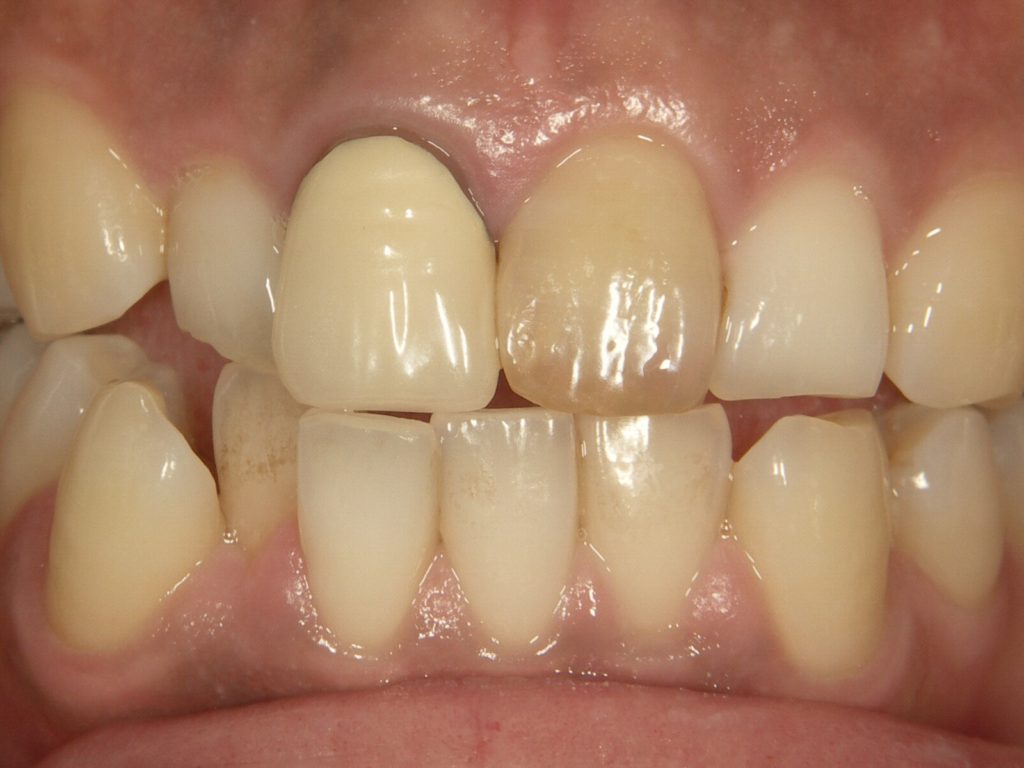 前歯(セラミック)が1本だけ色が違う!?変色した場合の最適な治療方法を紹介 | 恵比寿歯医者アンチエイジングデンタルクリニック