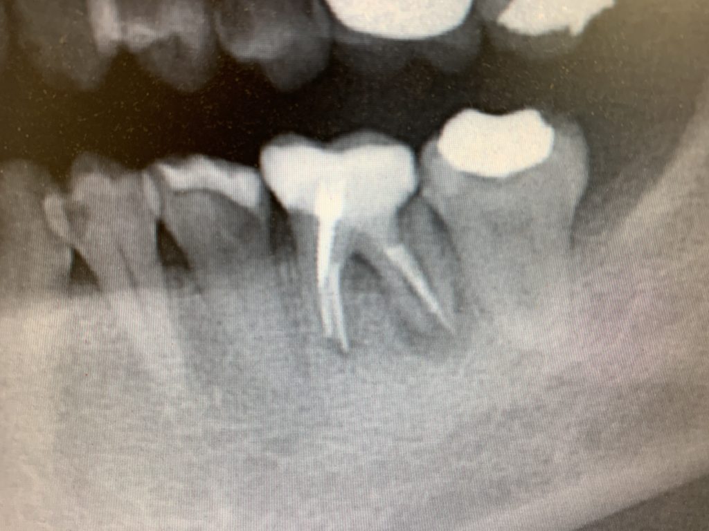 歯の破折　歯根破折