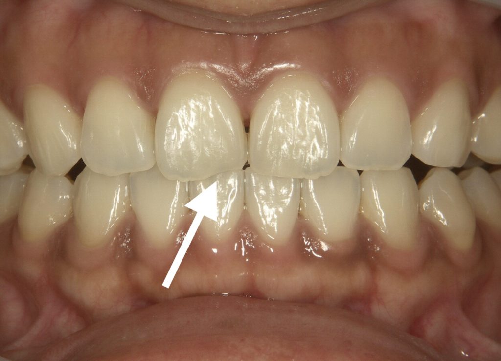 尖った犬歯 歯の先端の凸凹 ちょっと短い歯など 歯の形は少しの調整で審美的効果大