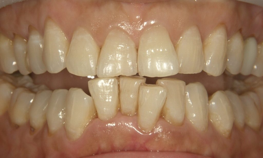 40代以降の矯正治療 前歯だけの部分矯正
